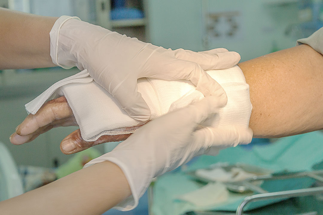 dressing burned wound hand with gauze pad, the patient needs a burn injury attorney